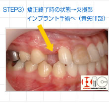 STEP3）矯正終了時の状態→欠損部インプラント手術へ（黄矢印部）