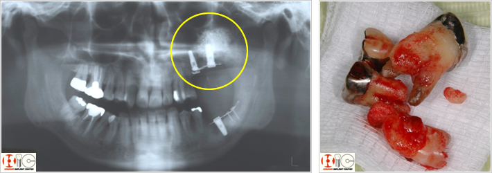 半埋伏小臼歯　チタンプレート　上顎洞開窓部